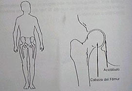 Prótesis de Cadera en Toluca