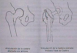 Prótesis de Cadera