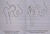 Prótesis de Cadera